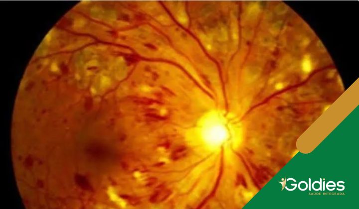 Retinopatia Diabética: entenda mais sobre a doença